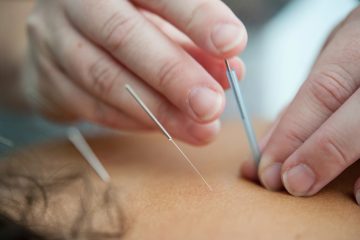Functional Integrated Needling